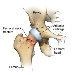 Front view of a hip bone and head of leg bone with neck fracture