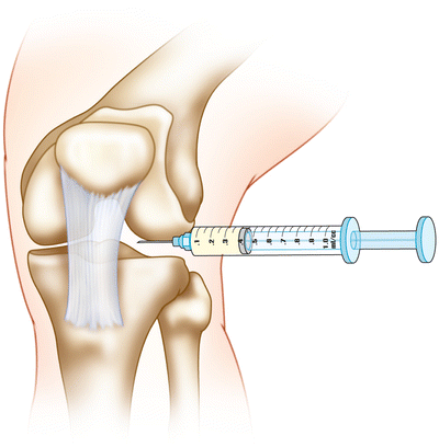 Intra-Articular Injections