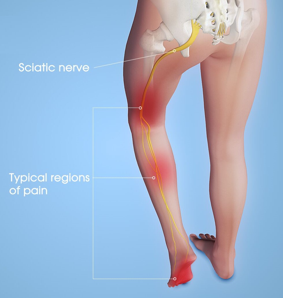 Sciatica Pain